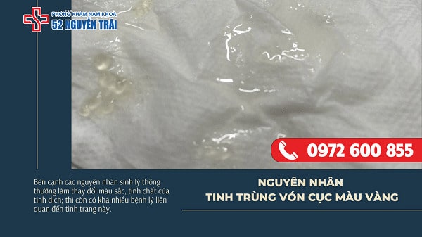 Những nguyên nhân khiến tinh dịch vón cục màu vàng