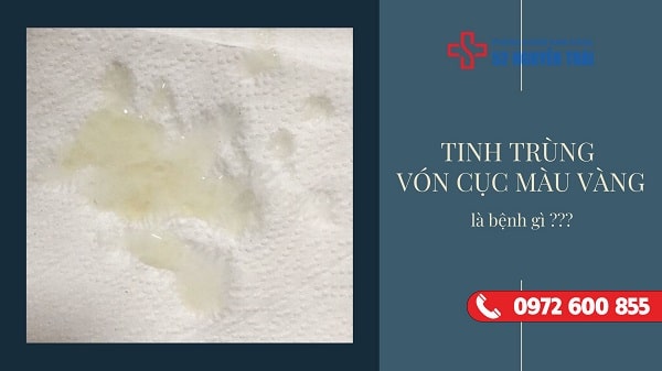 Tinh trùng vón cục màu vàng là bệnh gì ?