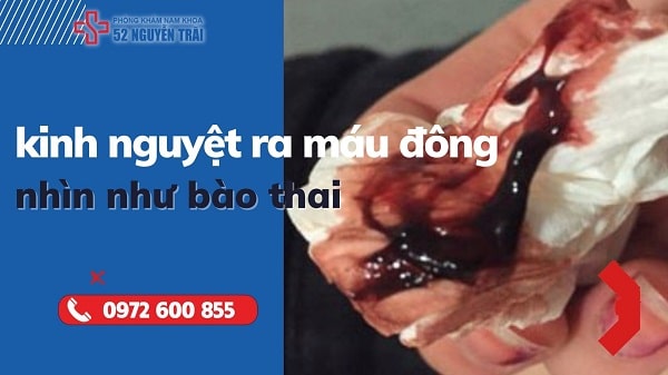 Hiện tượng kinh nguyệt ra máu đông nhìn như bào thai là do đâu ?